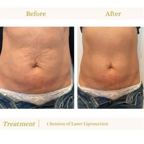 1 Week Laser Lipo Results