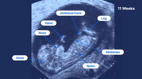 11 Week Pregnant Ultrasound