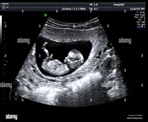 12 Week Fetus Ultrasound