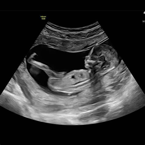 13 Week Gestation Ultrasound