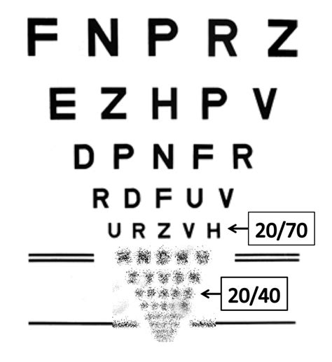 20 70 Vision