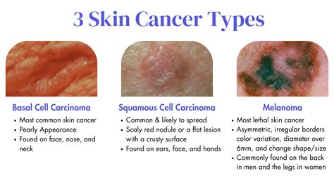 3 Types Of Skin Cancer