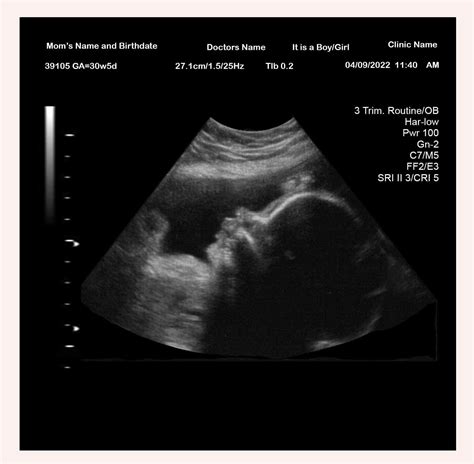 32 Week Ultrasound