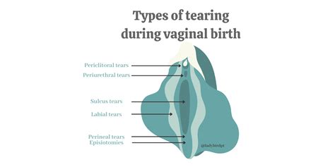 3Rd Degree Tear Childbirth