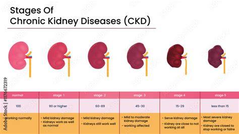3Rd Stage Kidney Disease