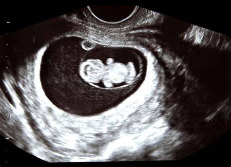 9Th Week Of Pregnancy Ultrasound