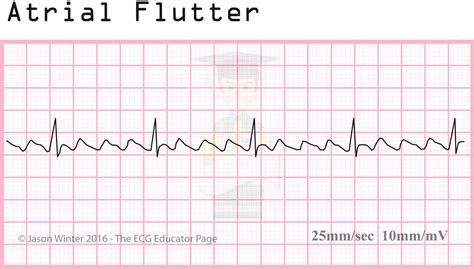 A Flutter Ecg