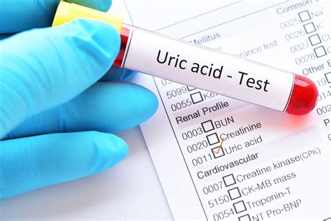 Abbreviation For Uric Acid On Blood Test