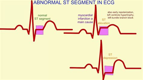 Abnormal Ekg Meaning