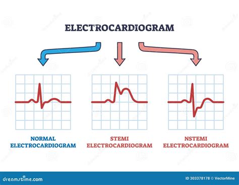 Abnormal Electrocardiogram