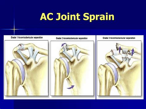 Ac Joint Sprain