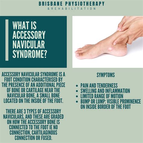 Accessory Navicular Syndrome