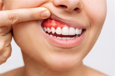 Ache In Gums