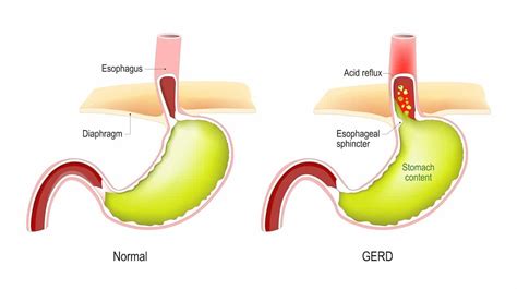 Acid Reflux And A Cough