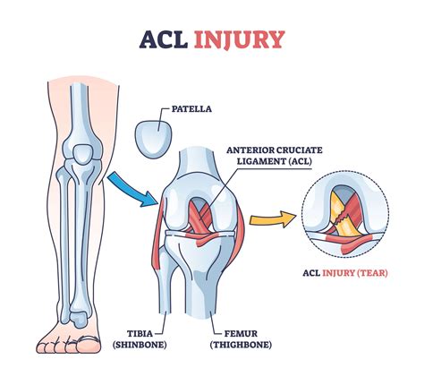 Acl Pain Location