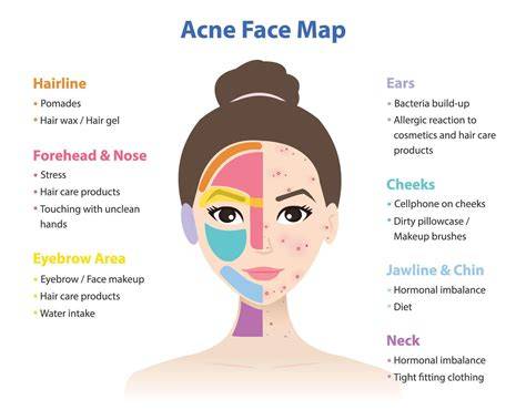 Acne Face Map