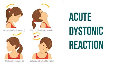 Acute Dystonic Reaction