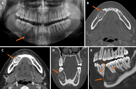 Adenomatoid Odontogenic Tumor