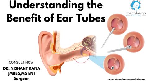 Adult Tubes Ears