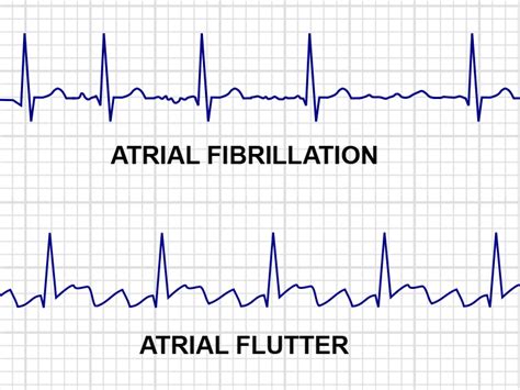 Afib Vs A Flutter
