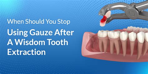 After Extracting Wisdom Teeth