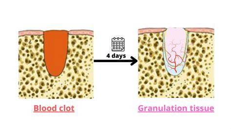 After Extraction Blood Clot