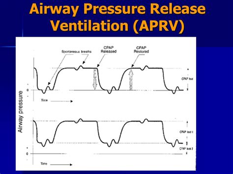 Airway Pressure Release Ventilation