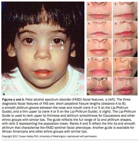Alcohol Fetal Syndrome Face