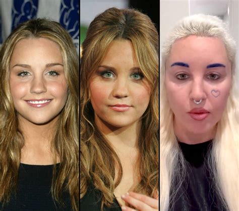Amanda Bynes Face Surgery
