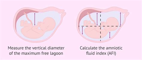 Amniotic Fluid Index