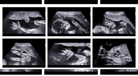 Anatomy Scan Ultrasound