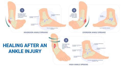 Ankle Injury Time To Heal