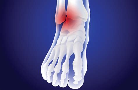 Ankle Pain Without Injury