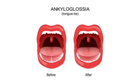 Ankyloglossia Vs Normal Tongue