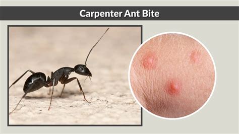 Ant Bite Pictures