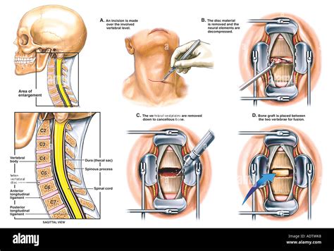 Anterior Cervical Discectomy