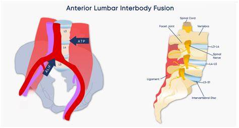 Anterior Lumbar Interbody Fusion