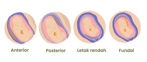 Anterior Placenta Belly Shape