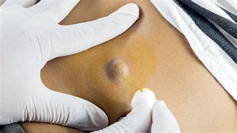 Antibiotic For Sebaceous Cyst Infection