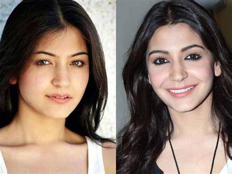 Anushka Sharma Face Surgery