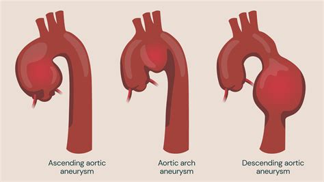 Aortic Arch Aneurysm