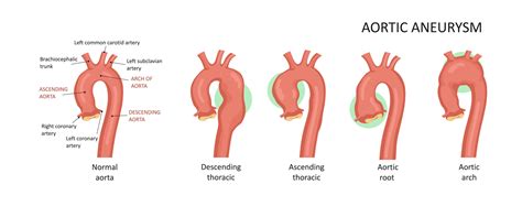 Aortic Root Dilatation