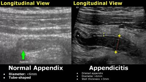Appendicitis On Ultrasound