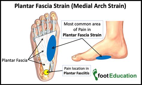 Arch Of Foot Pain