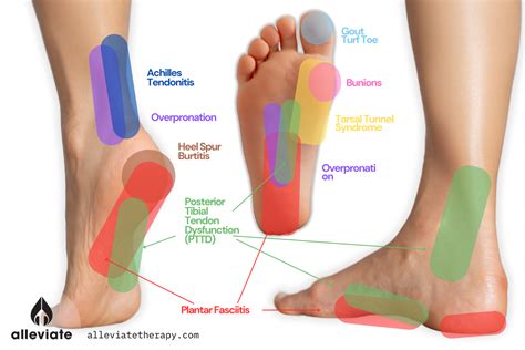 Arch Pain In Foot