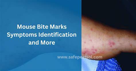 Are Bite Marks Dangerous