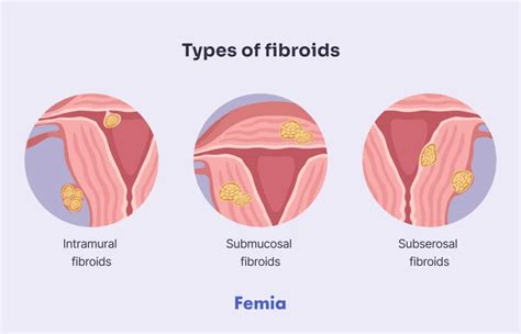 Are Fibroids Paristes