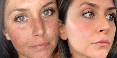 Are Freckles Sun Damage