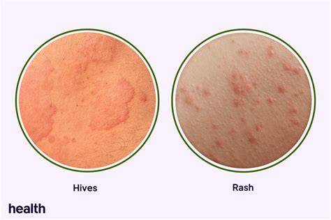 Are Hives Contagious