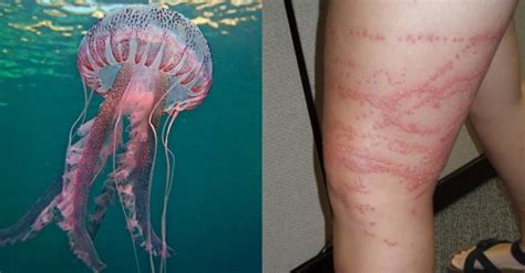 Are Jellyfish Immune To Their Own Stings